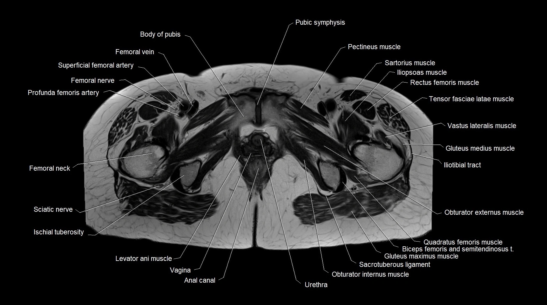 MRI 3T pelvis axial cross section anatomy image 28.webp